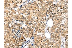 The image on the left is immunohistochemistry of paraffin-embedded Human breast cancer tissue using ABIN7192874(TPR Antibody) at dilution 1/20, on the right is treated with synthetic peptide. (TPR Antikörper)