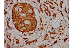 IHC image of ABIN7160033 diluted at 1:400 and staining in paraffin-embedded human pancreatic cancer performed on a Leica BondTM system. (MAP3K2 Antikörper  (AA 357-619))