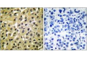 Immunohistochemistry analysis of paraffin-embedded human breast carcinoma tissue, using MDM2 Antibody. (MDM2 Antikörper  (AA 391-440))
