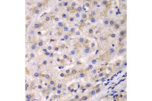 Immunohistochemistry of paraffin-embedded human liver cancer using EEF2 antibody at dilution of 1:100 (400x lens). (EEF2 Antikörper)