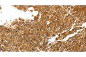 Immunohistochemistry of paraffin-embedded Human liver cancer tissue using TNXB Polyclonal Antibody at dilution 1:40 (TNXB Antikörper)