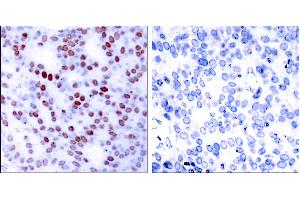 Peptide - +Immunohistochemical analysis of paraffin-embedded human breast carcinoma tissue using c-Jun (Ab-243) antibody (#B7130). (C-JUN Antikörper  (Ser243))