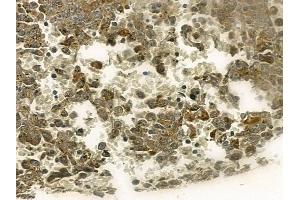 ABIN6256633 and ABIN6267212 at 1/100 staining human melanoma by IHC-P. (CDK6 Antikörper  (pTyr13))