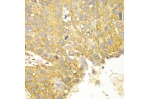 Immunohistochemistry of paraffin-embedded human lung cancer using ACTN1 antibody. (ACTN1 Antikörper  (AA 1-330))