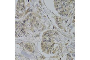 Immunohistochemistry of paraffin-embedded human breast cancer using AKT1S1 Antibody (ABIN5973672) at dilution of 1/100 (40x lens). (PRAS40 Antikörper)