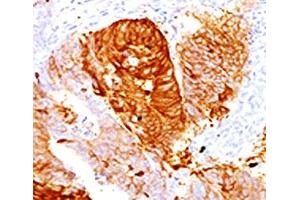IHC testing of FFPE human colon carcinoma with ALDH1 antibody (clone AHDH1-1). (ALDH1A1 Antikörper  (AA 315-434))