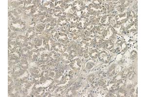 ABIN6265762 and ABIN6268946 at 1/100 staining human renal cell carcinoma by IHC-P. (TXNRD2 Antikörper  (C-Term))
