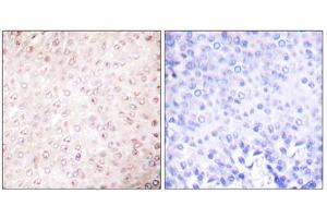 Immunohistochemical analysis of paraffin-embedded human breast carcinoma tissue using P300/CBP Antibody (ABIN5976479). (CBP Antikörper  (C-Term))
