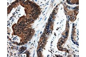 Immunohistochemical staining of paraffin-embedded liver tissue using anti-L1CAM mouse monoclonal antibody. (L1CAM Antikörper)