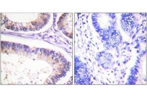 Immunohistochemistry analysis of paraffin-embedded human colon carcinoma, using CBL (Phospho-Tyr674) Antibody. (CBL Antikörper  (pTyr674))