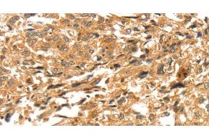 Immunohistochemistry of paraffin-embedded Human esophagus cancer tissue using DIRAS1 Polyclonal Antibody at dilution 1:52 (DIRAS1 Antikörper)
