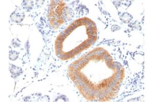 Formalin-fixed, paraffin-embedded human Melanoma stained with CD86 Mouse Monoclonal Antibody (C86/1146). (CD86 Antikörper)