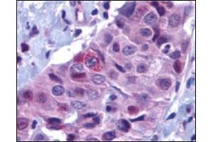 Immunohistochemistry of PUMA in human breast carcinoma with PUMA antibody at 10 μg/ml. (PUMA Antikörper  (N-Term))