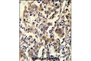CCD Antibody (C-term) (ABIN655703 and ABIN2845154) immunohistochemistry analysis in formalin fixed and paraffin embedded human testis carcinoma followed by peroxidase conjugation of the secondary antibody and DAB staining. (CCDC110 Antikörper  (C-Term))