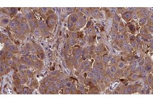 ABIN6273856 at 1/100 staining Human liver cancer tissue by IHC-P.