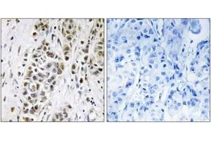 Immunohistochemistry analysis of paraffin-embedded human breast carcinoma tissue, using XRN2 Antibody. (Renin-2 Antikörper  (AA 81-130))