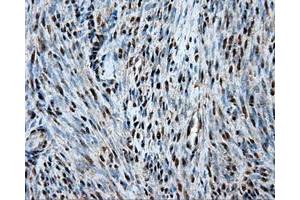 Immunohistochemical staining of paraffin-embedded Adenocarcinoma of ovary tissue using anti-HSPA1Amouse monoclonal antibody. (HSP70 1A Antikörper)