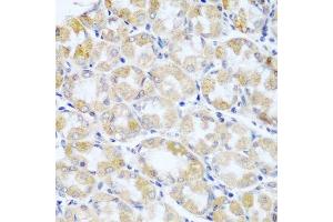 Immunohistochemistry of paraffin-embedded human stomach cancer using ANKRD52 antibody. (ANKRD52 Antikörper  (AA 450-660))