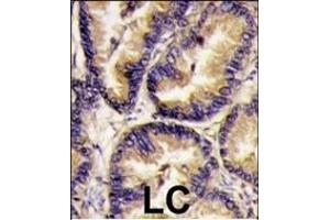 Formalin-fixed and paraffin-embedded human lung carcinoma tissue reacted with VEGF2 antibody (Center) (ABIN390259 and ABIN2837933) , which was peroxidase-conjugated to the secondary antibody, followed by DAB staining. (VEGFB (VEGF2) (AA 110-139) Antikörper)