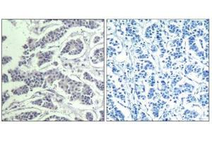 Immunohistochemical analysis of paraffin-embedded human breast carcinoma tissue using AKT1/AKT2/AKT3(Phospho-Tyr315/316/312) Antibody(left) or the same antibody preincubated with blocking peptide(right). (AKT 1/2/3 Antikörper  (pTyr312, pTyr315, pTyr316))