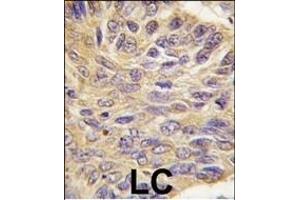 Formalin-fixed and paraffin-embedded human lung carcinoma tissue reacted with MEG2 antibody (C-term), which was peroxidase-conjugated to the secondary antibody, followed by DAB staining. (PTPN9 Antikörper  (C-Term))