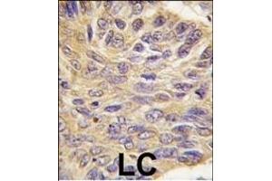 Formalin-fixed and paraffin-embedded human lung carcinoma tissue reacted with MEG2 antibody (C-term), which was peroxidase-conjugated to the secondary antibody, followed by DAB staining.
