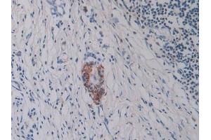 Detection of Hepc in Human Pancreatic cancer Tissue using Monoclonal Antibody to Hepcidin (Hepc) (Hepcidin Antikörper  (AA 25-84))