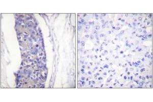 Immunohistochemistry analysis of paraffin-embedded human breast carcinoma tissue, using Tubulin alpha Antibody. (alpha Tubulin Antikörper)