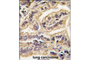 Formalin-fixed and paraffin-embedded human lung carcinoma tissue reacted with CSF1R polyclonal antibody  , which was peroxidase-conjugated to the secondary antibody, followed by DAB staining. (CSF1R Antikörper  (C-Term))