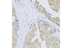 Immunohistochemistry of paraffin-embedded human liver cancer using ARFGAP3 antibody (ABIN5974520) at dilution of 1/100 (40x lens). (ARFGAP3 Antikörper)