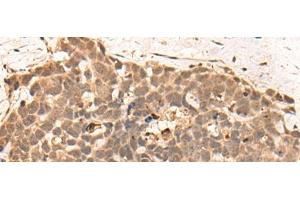 Immunohistochemistry of paraffin-embedded Human thyroid cancer tissue using CLK2 Polyclonal Antibody at dilution of 1:45(x200) (CLK2 Antikörper)