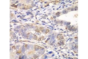 Immunohistochemistry of paraffin-embedded Human gastric cancer using GCLM Polyclonal Antibody at dilution of 1:100 (40x lens). (GCLM Antikörper)