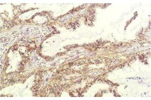 Immunohistochemistry of paraffin-embedded Human lung carcinoma tissue using IL8 Monoclonal Antibody at dilution of 1:200. (IL-8 Antikörper)