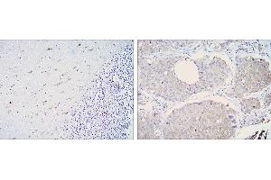 Immunohistochemical analysis of paraffin-embedded cerebellum tissues (left) and lung cancer (right) using ALDH1A1 mouse mAb with DAB staining. (ALDH1A1 Antikörper)
