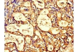 Immunohistochemistry of paraffin-embedded human gastric cancer using ABIN7171428 at dilution of 1:100 (CCT8 Antikörper  (AA 224-491))