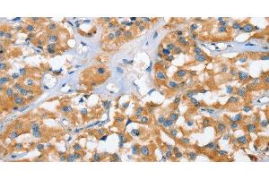Immunohistochemistry of paraffin-embedded Human thyroid cancer tissue using CXCL14 Polyclonal Antibody at dilution 1:40 (CXCL14 Antikörper)