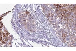 ABIN6277846 at 1/100 staining Human urothelial cancer tissue by IHC-P. (INSRR Antikörper  (N-Term))