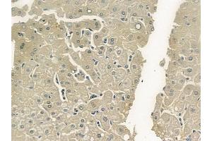 ABIN6263420 and ABIN6273269 at 1/100 staining human hepatocellular carcinoma by IHC-P.