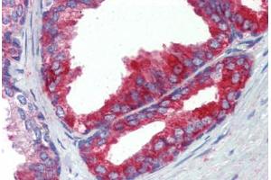 Human Prostate (formalin-fixed, paraffin-embedded) stained with FASN antibody ABIN462322 followed by biotinylated goat anti-rabbit IgG secondary antibody ABIN481713, alkaline phosphatase-streptavidin and chromogen. (Fatty Acid Synthase Antikörper  (AA 942-973))