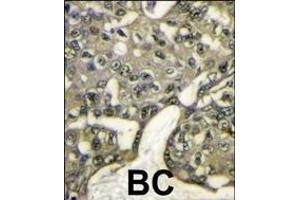 Immunohistochemistry (Paraffin-embedded Sections) (IHC (p)) image for anti-V-Akt Murine Thymoma Viral Oncogene Homolog 1 (AKT1) (AA 115-144), (N-Term) antibody (ABIN391212)
