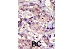 Formalin-fixed and paraffin-embedded human cancer tissue reacted with PDGFRA polyclonal antibody  , which was peroxidase-conjugated to the secondary antibody, followed by DAB staining. (PDGFRA Antikörper  (C-Term))