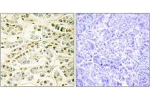 Immunohistochemistry analysis of paraffin-embedded human pancreas tissue, using RAD51L1 Antibody. (RAD51 Homolog B Antikörper  (AA 201-250))