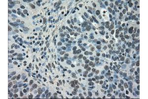 Immunohistochemical staining of paraffin-embedded Carcinoma of kidney tissue using anti-NEK6mouse monoclonal antibody. (NEK6 Antikörper)