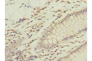 Immunohistochemistry of paraffin-embedded human colon cancer using ABIN7168218 at dilution of 1:100 (GFM2 Antikörper  (AA 520-779))