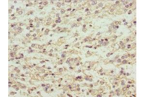 Immunohistochemistry of paraffin-embedded human glioma using ABIN7159294 at dilution of 1:100 (MAGED1 Antikörper  (AA 579-778))