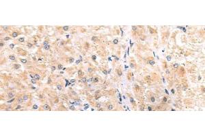 Immunohistochemistry of paraffin-embedded Human liver cancer tissue using ITGA3 Polyclonal Antibody at dilution of 1:45(x200) (ITGA3 Antikörper)