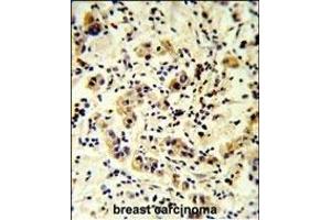 CC50B Antibody (N-term) (ABIN651159 and ABIN2840104) IHC analysis in formalin fixed and paraffin embedded human breast carcinoma followed by peroxidase conjugation of the secondary antibody and DAB staining. (TMEM30B Antikörper  (N-Term))