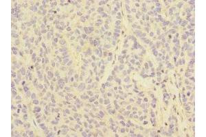 Immunohistochemistry of paraffin-embedded human ovarian cancer using ABIN7158546 at dilution of 1:100