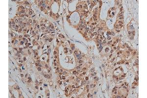 ABIN6255221 and ABIN6267478 at 1/50 staining human colon cancer tissue sections by IHC-P. (beta Catenin Antikörper  (pSer33))