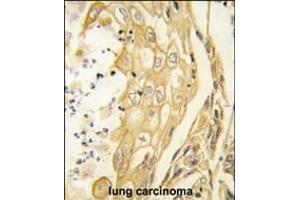 Formalin-fixed and paraffin-embedded human lung carcinoma tissue reacted with the EphB4 antibody (ABIN391924 and ABIN2841734) , which was peroxidase-conjugated to the secondary antibody, followed by DAB staining. (EPH Receptor B4 Antikörper)